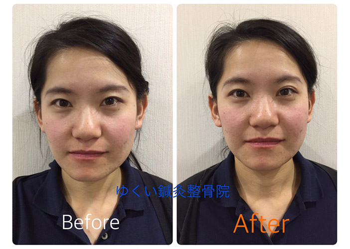 美容鍼ビフォーアフター